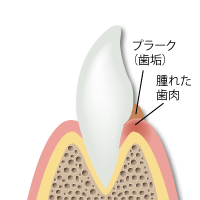 歯肉炎