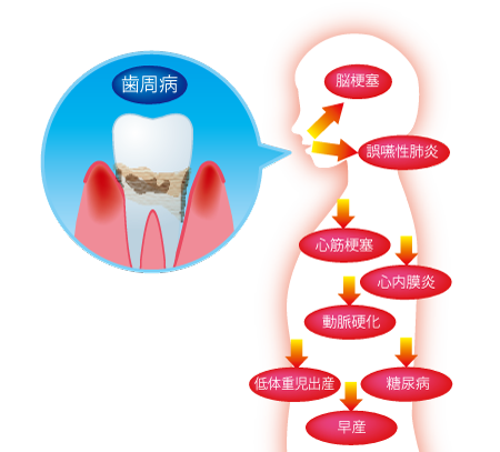 歯周病と全身疾患